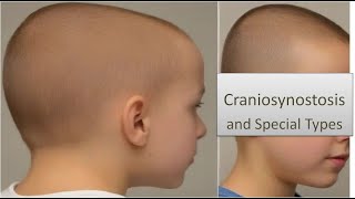 Craniosynostosis and Special Types [upl. by Bridie186]