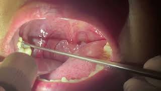 How to remove Tonsil Stones  Immediate Relief after TONSIL STONE Removal [upl. by Schellens]