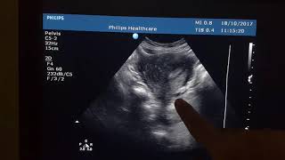 Bicornuate Uterus with IUCD sonography [upl. by Assirec]