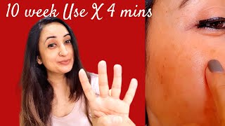 Be Minimalist Tranexamic AcidSerum 10 WEEK Live Result Mini Product Review 4Min Review [upl. by Atikel864]