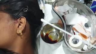 Preauricular sinus abscess aspiration Patient teaching programme Tamil [upl. by Eibreh]