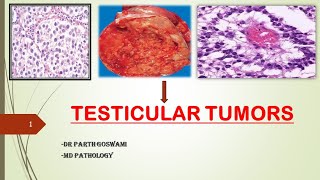 Testicular Tumors  Germ cell amp Sex cord Stromal Tumors  Seminoma [upl. by Alehc]