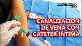 🔴 COLOCACION DE SAFT INTIMA VIA ENDOVENOSA [upl. by Noonberg]