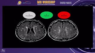 Supratentorial MS lesions  ESNPN Worshop Arabic [upl. by Akimahc360]