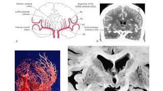 The lenticulostriate vessels and lacunar infarcts [upl. by Setiram]