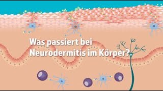 Was passiert bei Neurodermitis im Körper [upl. by Dombrowski590]