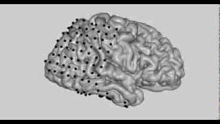 Functional Mapping for Epilepsy [upl. by Koressa511]