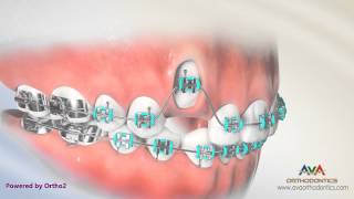 Orthodontic Treatment for Impacted Canine  Laser Exposure [upl. by Annahoj]