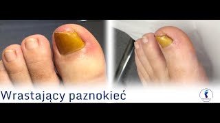 Po usuwaniu wrastającego paznokcia  wizyta kontrolna  After ingrown nail removal  control visit [upl. by Ryder]