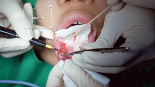 Mucocele removal surgery 입술점액낭종  JUDITH PS KOREA 유디트성형외과 [upl. by Kamat]