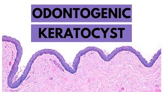 Odontogenic Keratocyst Clinical features Radiology Histology and Treatment [upl. by Cowey]