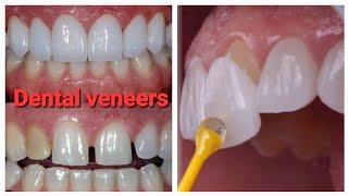 Dental VeneersTeeth VeneersCosmatic Dentistry [upl. by Roselia513]