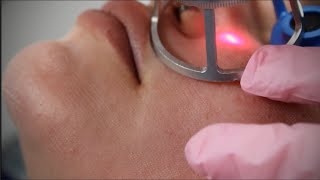 Rohrer Aesthetics Phoenix CO2 Laser System Overview [upl. by Liberati]