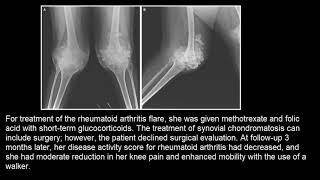 Synoviale Chondromatose [upl. by Ag]