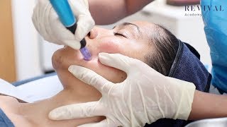 Microneedling Full Training Video [upl. by Segroeg]