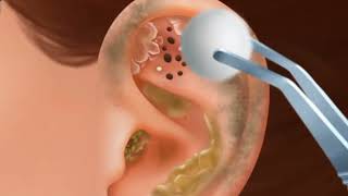 Itchy amp Smelly Ear Stone Removal Digging Out Super Big Earwax  ASMR Animation  Mengs Stop Motion [upl. by Nemlaz]