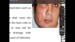 Odontogenic infections4th stage oral surgery part2 [upl. by Alihet720]