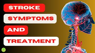 👉CAN WE PREVENT BRAIN HEMORRHAGE 【STROKE SYMPTOMS AND TREATMENT】 [upl. by Llehsar880]