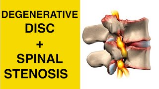 Sciatica Exercises  Stretches for Spinal Stenosis amp Degenerative Disc Disease Treatment [upl. by Christoffer735]