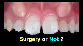 Solving Upper Impacted canines｜【Chris Chang Ortho】CC792 [upl. by Shear]