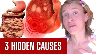 The Hidden Truth What REALLY Causes Gastritis SURPRISE [upl. by Notyrb852]