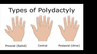 Webinar on Polydactyly Session 1 [upl. by Fakieh]