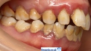 Treatment of Periodontal DiseaseBefore and After [upl. by Ellary]