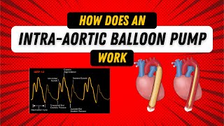 How Does an Intra Aortic Balloon Pump Work Guide for Nurses [upl. by Crawley]