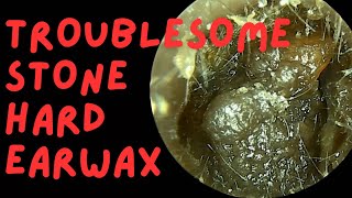 Troublesome Stone Hard Earwax [upl. by Yenitirb421]