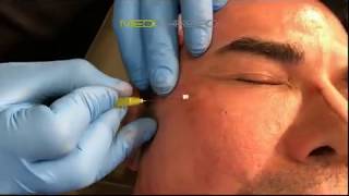 PDOTHREAD LIFT PROCEDURE BY MEDiTHREAD  Eyes [upl. by Cordula]