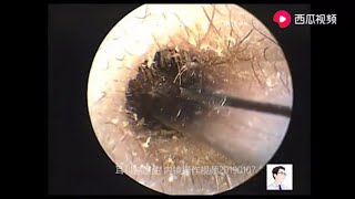 Treatment of rigid external auditory canal enucleation [upl. by Winson]