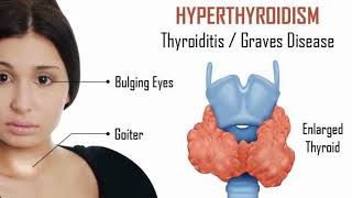 clinical case presentation Hyperthyroidism or Graves disease [upl. by Chamberlin]