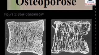 Ostéoporose Conduite à Tenir Traitement Prévention des Fractures [upl. by Esmaria]