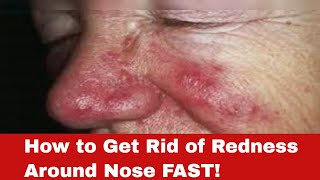 Red Nose No More How to Get Rid of Redness Around Nose FAST [upl. by Candace]