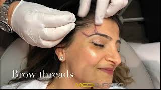 PDOTHREAD LIFT PROCEDURE BY MEDiTHREAD  Eyebrow Lift [upl. by Eanyl]