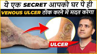 How To Treat Veins Ulcer In Leg At Home  Dr Gaurav Gangwani Interventional Radiologist [upl. by Anivel]