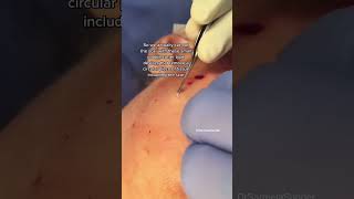 Deep Acne Scars  Ice Pick Scar Treatment [upl. by Nutter]