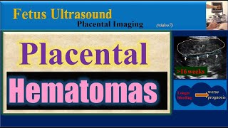 Fetus Ultrasound Placental Hematomas [upl. by Cullin]