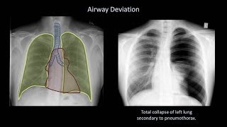 How to Interpret a Chest XRay Lesson 4  Airways Bones and Soft Tissues [upl. by Naujit493]