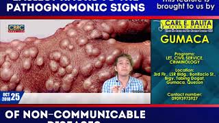 Pathognomonic Signs in Communicable Disease Part 2 by Janus de Leon [upl. by Silvestro]