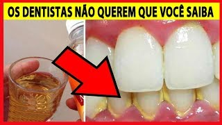 Meu Amigo DENTISTA Me Ensinou Como REMOVER TÁRTARO em Casa Dessa Forma Tártaro [upl. by Angadreme513]