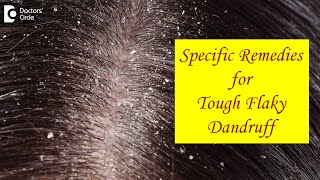 FLAKY SCALP DANDRUFF not cleared by Home Remedies What to do  Dr Amee Daxini  Doctors Circle [upl. by Cointon]