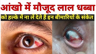 आंख लाल होने का कारण  subconjunctival hemorrhage in hindi  subconjunctival hemorrhage treatment [upl. by Ainattirb812]