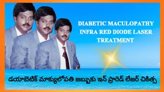 DIABETIC MACULOPATHY INFRA RED DIODE LASER TREATMENT  DrBSUBBARAO [upl. by Oeram422]