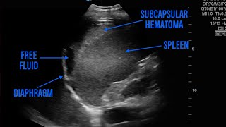 Splenic Trauma [upl. by Katlin]