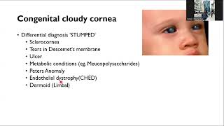 Congenital Anomalies of Cornea and Classification of Corneal Disease part 1 [upl. by Dnomad]