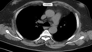 Cross sectional and imaging anatomy of the thorax [upl. by Kazimir]