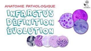 Anatomie Pathologique  Infarctus Définition évolution [upl. by Nairod]