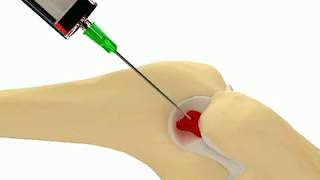 Elbow Olecranon Fossa Injection [upl. by Binky]