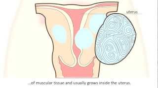 Fibroid  What is a fibroid and how can it be treated [upl. by Kjersti]